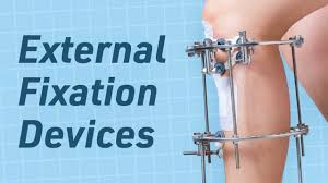 External Fixation - Unique Surgicare